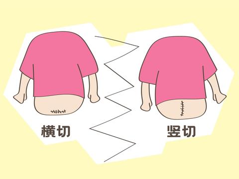剖腹产选择竖切还是横切，原来这里有学问，不要盲目选择！|剖腹产|顺产|刀口|伤口|露脐装_新浪新闻