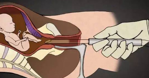 分析;人流后内膜薄能恢复吗