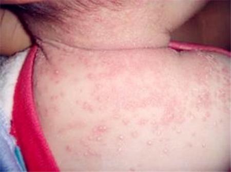 为什么宝宝秋季也会长痱子?