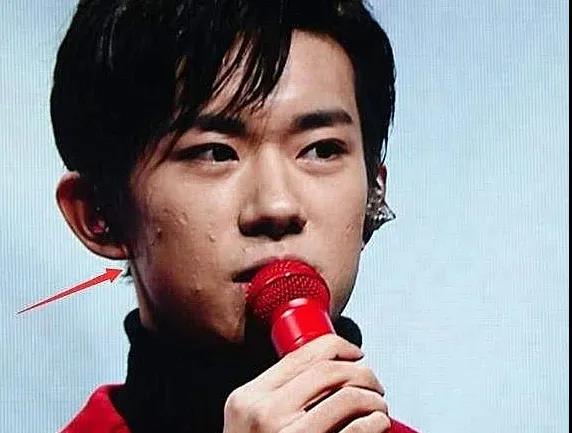 tfboys生图:王俊凯青春痘,王源痘痘肌,而易烊千玺让人更失望