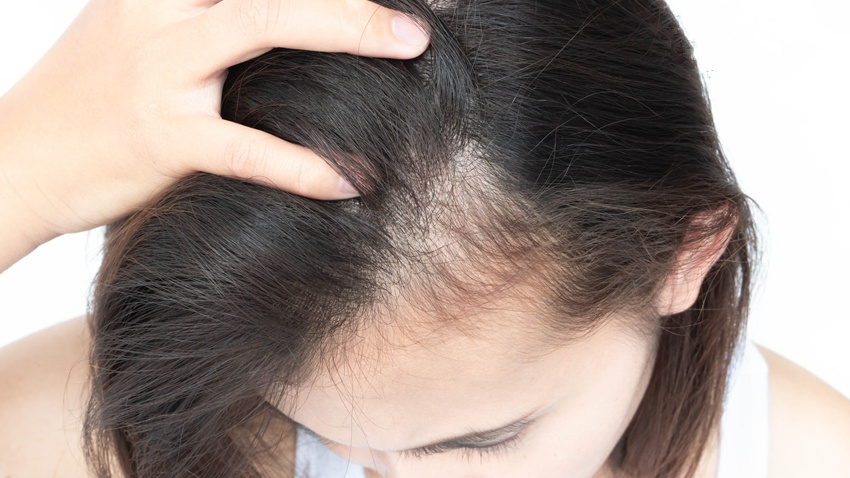 女性掉发原因多体质湿热气血虚压力大你是哪一种