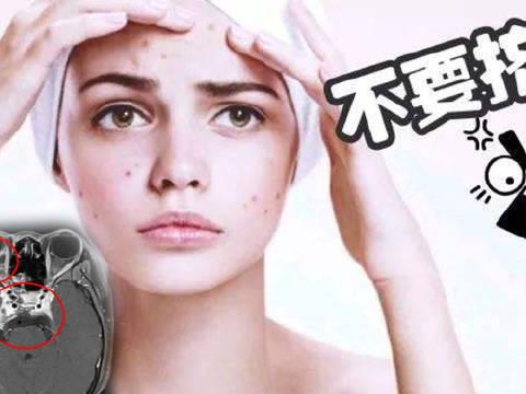 19岁宁波女孩挤痘痘被送进抢救室