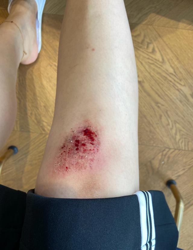 不轻言放弃女排重炮手仍在苦苦坚持疑似因训练而摔破膝盖