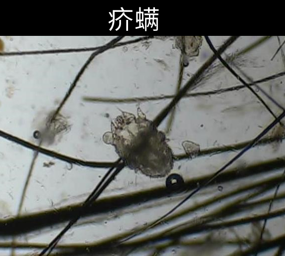 螨虫叮咬后的症状图?人身上被螨虫咬的图片?螨虫怎么去除?