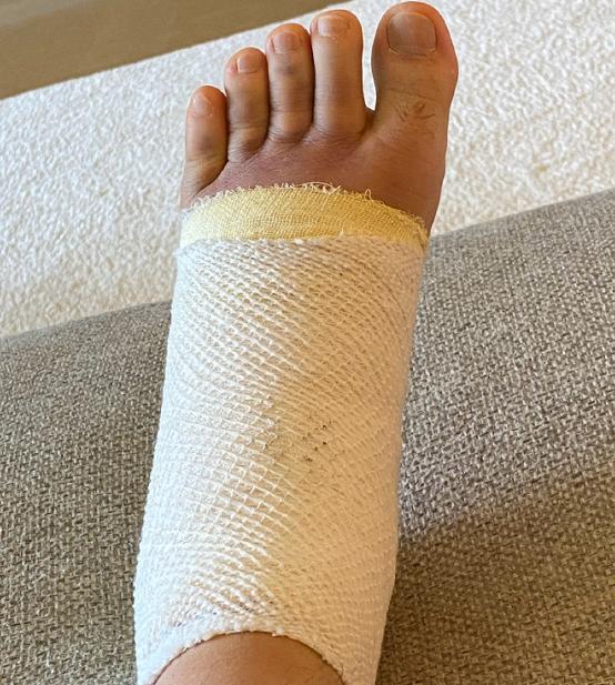 "同时还晒出两张自己脚的照片,画面中庾澄庆的脚肿成了"肉包",上面缠