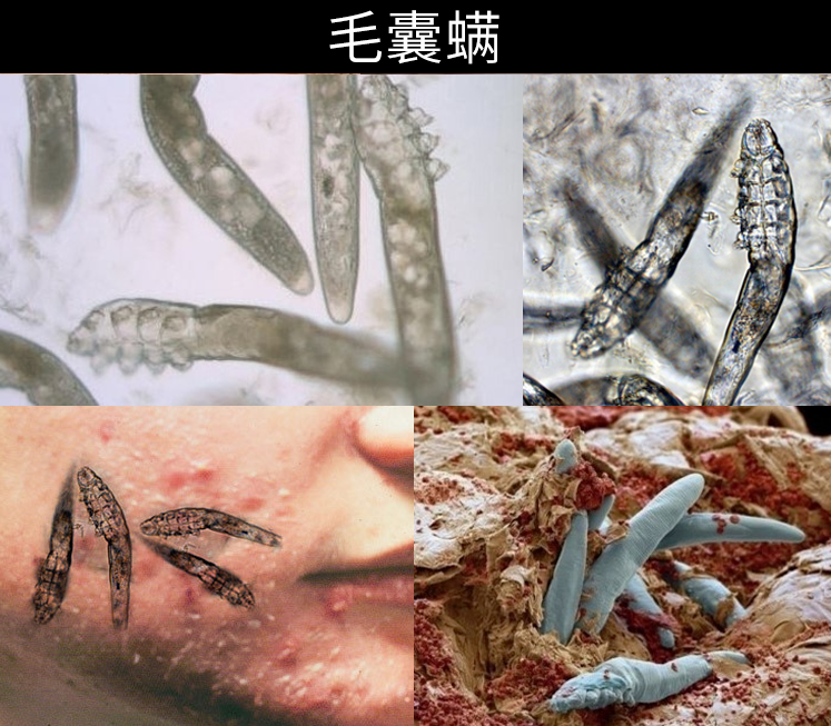 螨虫|净螨|毛囊_新浪新闻