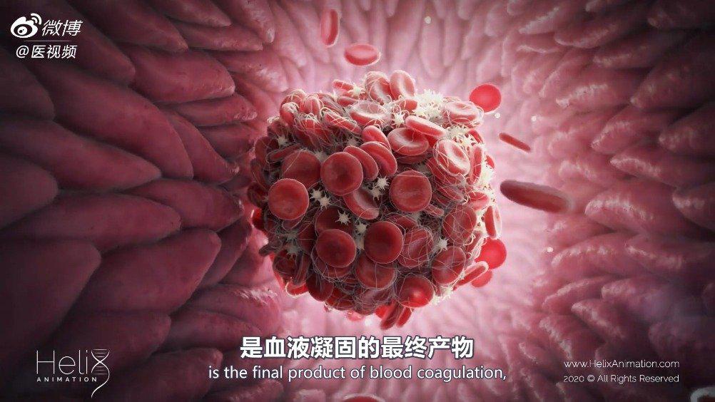 医学双语科普:血液凝固的级联反应_新浪新闻