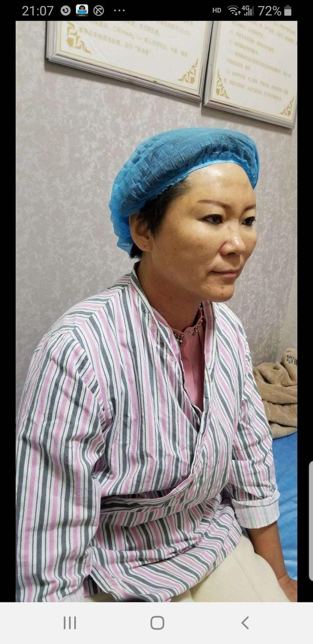 姑姑小拉皮手术后7天照片,做拉皮手术后的图片你敢看吗?