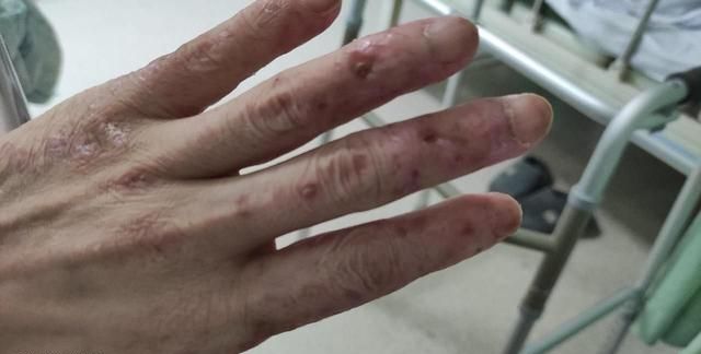 男子四肢长怪异皮疹一年医生抽丝剥茧找出病因