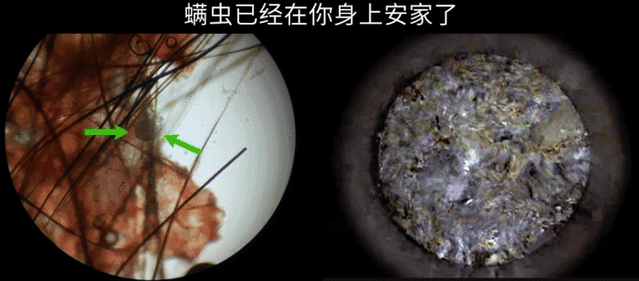 怎么判断脸上有螨虫被螨虫咬了脸上挤出硬粒是螨虫吗