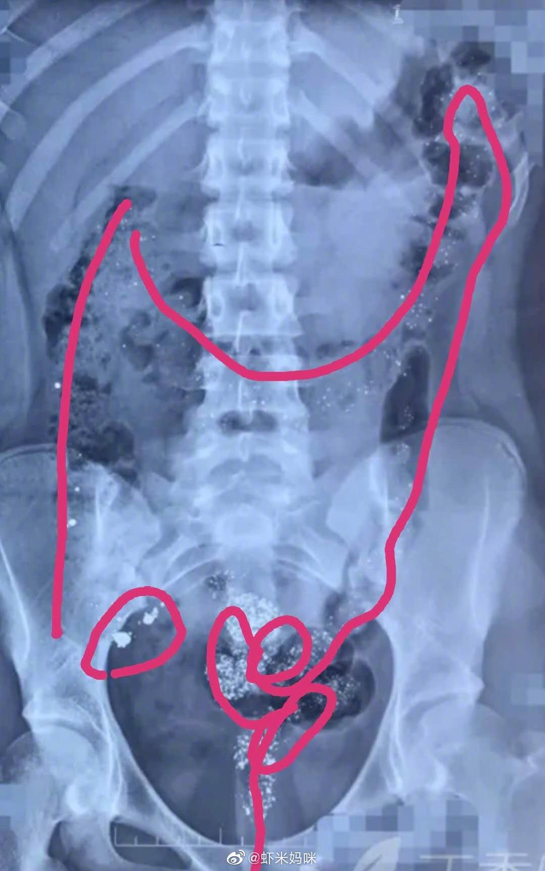 13岁女孩打碎17支水银体温计喝下 引发的儿童汞中毒案例讨论休闲区蓝鸢梦想 - Www.slyday.coM 13岁女孩打碎17支水银体温计喝下 引发的儿童汞中毒案例讨论休闲区蓝鸢梦想 - Www.slyday.coM