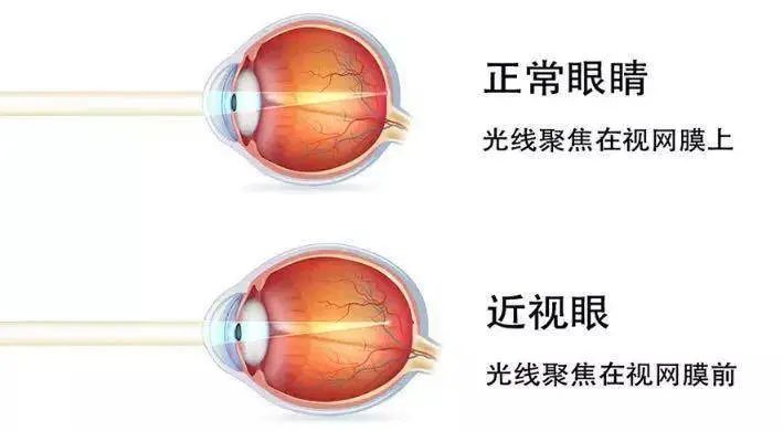 盘点 7 种超火方法,当心白花钱还伤眼睛|近视_新浪新闻
