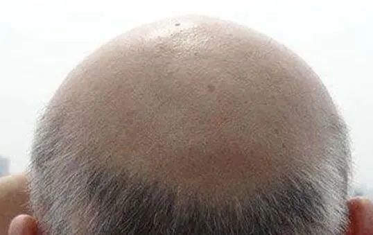 脱发后怎样做才能维持毛囊不退化呢?