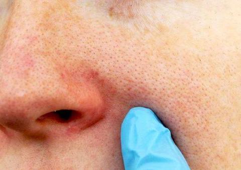 明明每次都做好了皮肤清洁,在用手轻轻挤压鼻子,特别是鼻翼两侧时