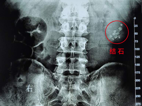 结石体质怎么办