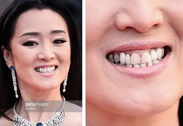 女神巩俐,也没有逃过换牙的诱惑,之前健康正常的大牙,处理之后牙龈