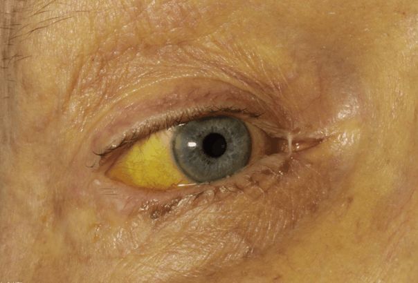 肝癌最会"伪装",医生:身体出现4个表现,趁早去查一查肝功!