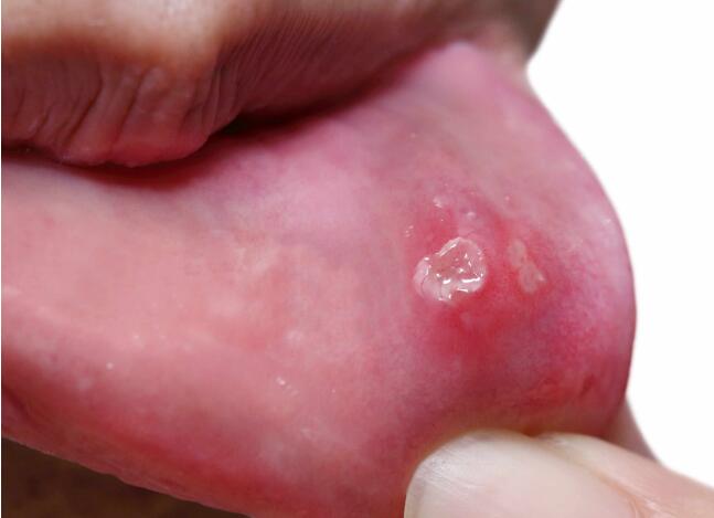 口腔溃疡会不会发生癌变?若出现这5种症状,请及时检查,别忽视