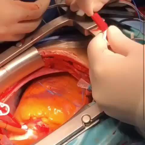 看看心脏的电击起搏