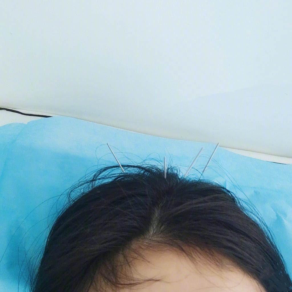 杨幂做头部针灸引粉丝心疼,自嘲是"信号增强狐"脑洞大开