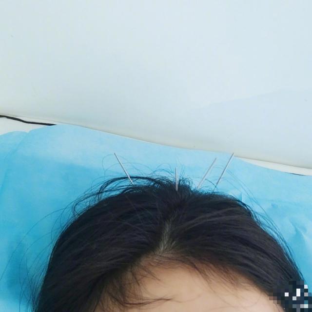 34岁杨幂晒针灸照,一头银针画面吓人,女明星中医治疗方法多