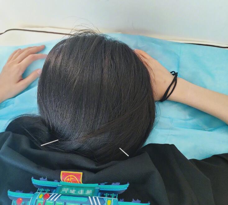 杨幂晒头部针灸照像天线宝宝,自侃是信号增强狐,发量令人羡慕