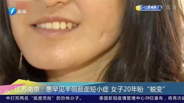 江苏南京:患罕见半侧颜面短小症,女子20年盼"蜕变"