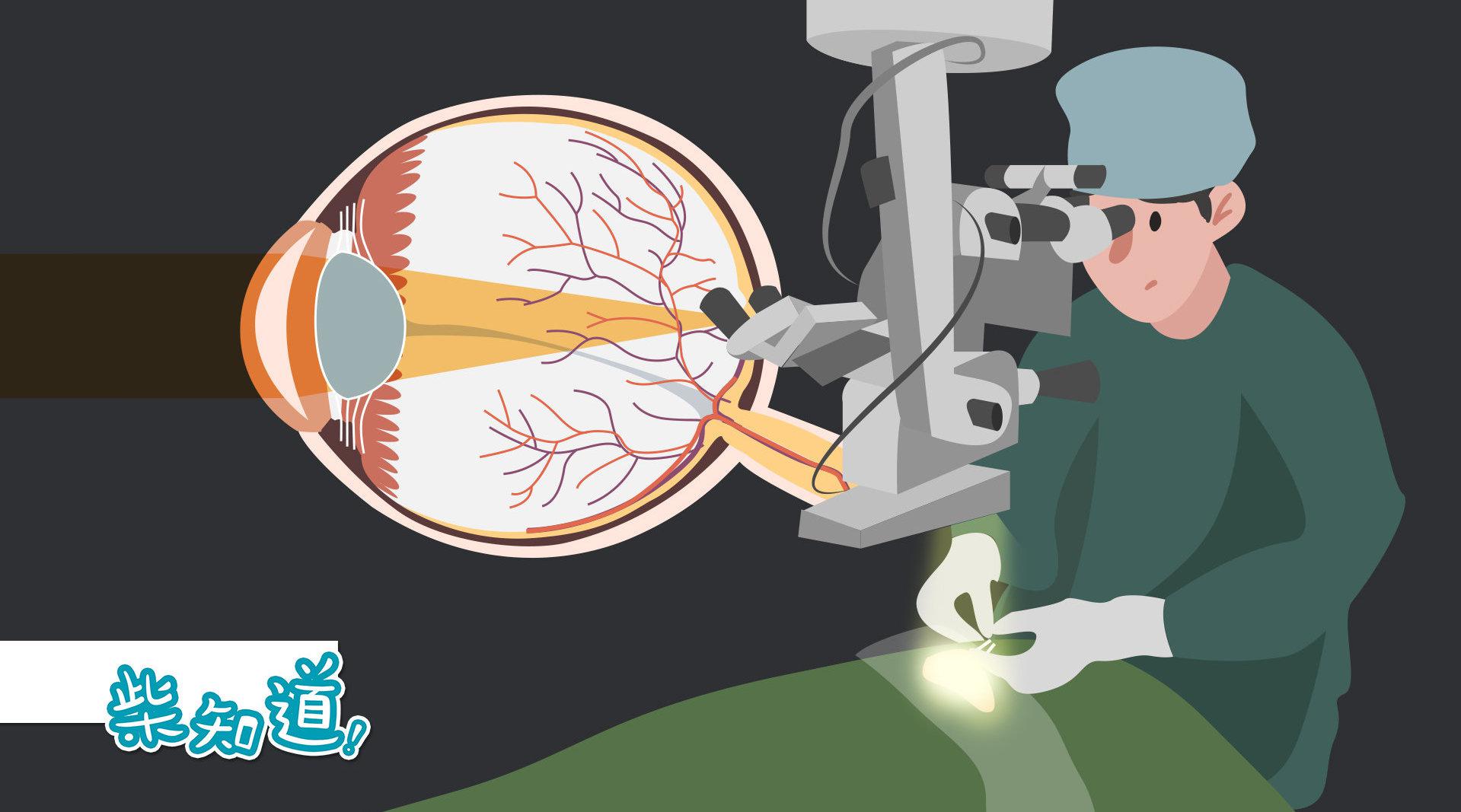 医学动画科普:不同的近视手术有何区别?