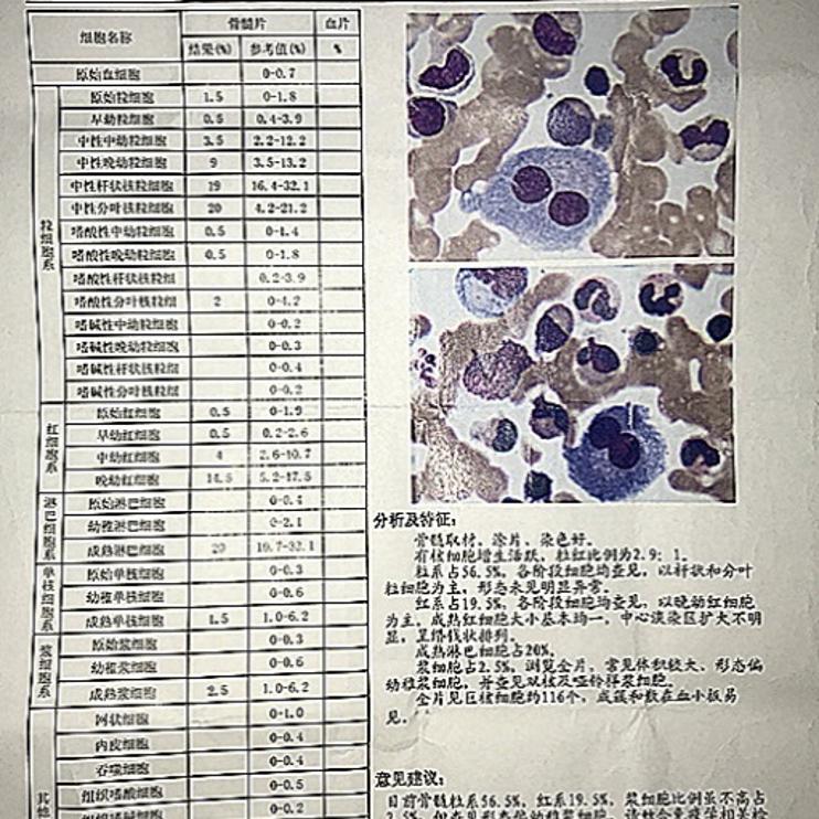"浆细胞瘤是起源于骨髓的一种原发性的和全身性的恶性肿瘤,来源于b