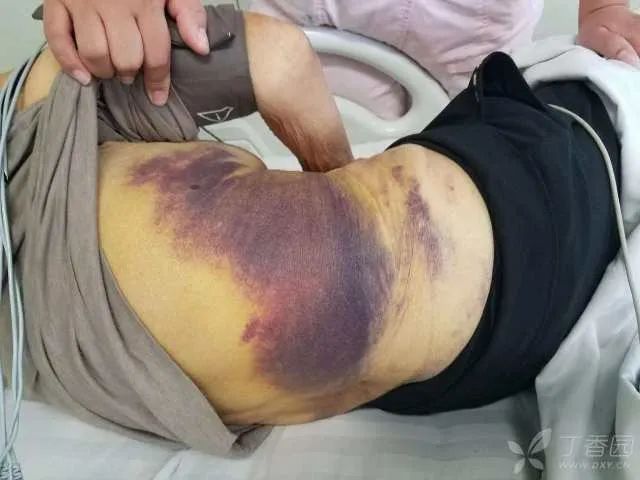 81 岁老太太背部大面积瘀斑,病人主诉轻微,医生却吓得不轻!