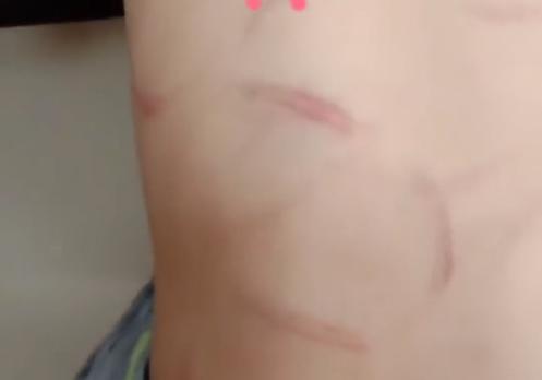 云南文山7岁男孩被继母打得伤痕累累原因竟是亲妈气得报警