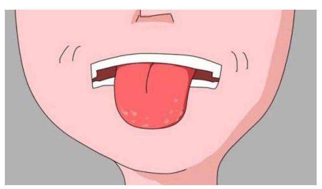裂舌纹:日常生活中,正常的舌头应该是光滑的,如果你出现了裂纹舌