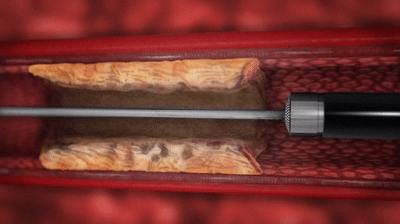 除了心脏搭桥,小激光帮你打通心血管|新技术|斑块|支架_新浪新闻