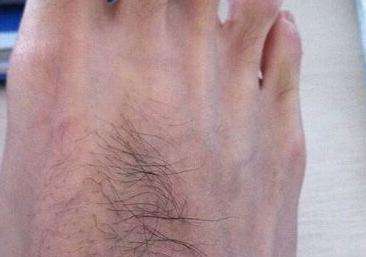脚背有毛如果脚背有毛呢,这样会分成两种,如果脚上的毛细而软,那么该
