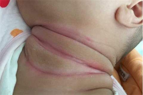 小儿推拿杨晓:夏天宝宝"淹脖子"是怎么回事?如何预防护理?