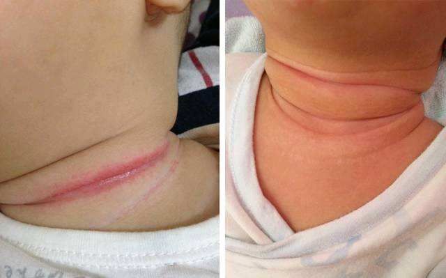 小儿推拿杨晓:夏天宝宝"淹脖子"是怎么回事?如何预防护理?