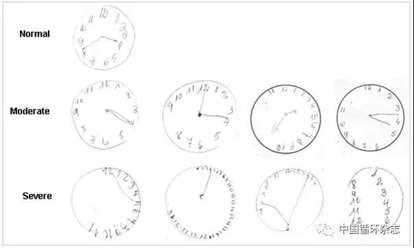 不同程度认知障碍高血压患者的画钟试验结果举哑铃可以帮助预防痴呆