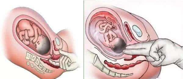 第一阶段:宫口开全的过程,也就是从开1指到10指的过程,这个阶段耗时