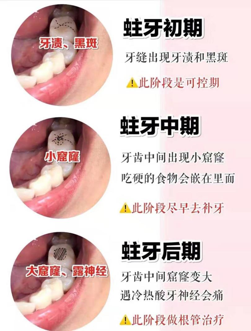 牙齿上的小黑点为什么刷不掉到底是什么别让侥幸毁了你一口牙
