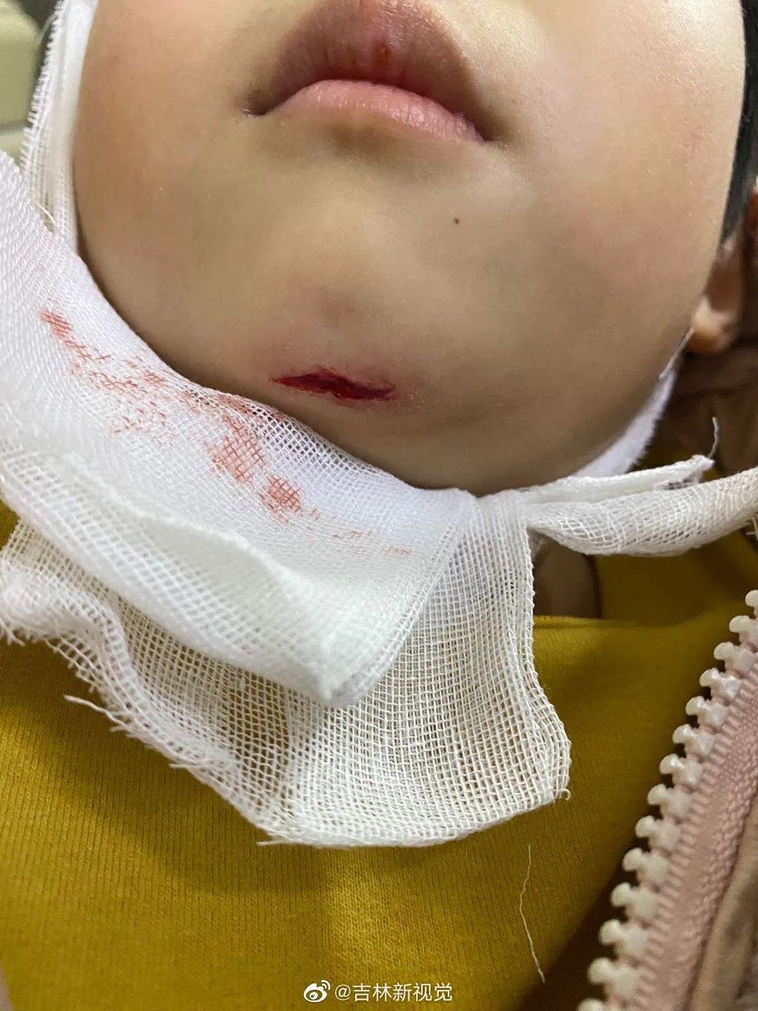 吉林市3岁宝宝在热带雨林浴场摔伤,拒绝赔偿让走保险?