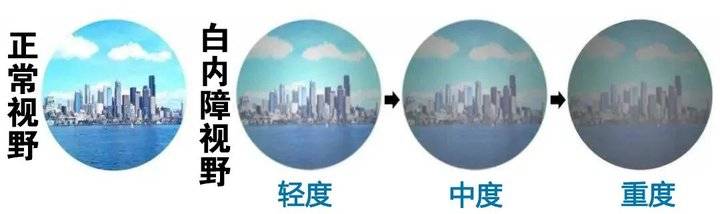 白内障是世界第一致盲眼病.