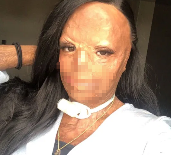 励志英国美女意外烧伤毁容面目全非如今成功当上美妆博主