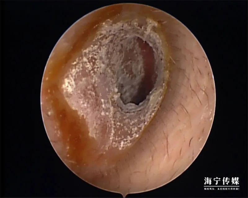 小伙采耳后 耳朵里竟然 发霉了 手机新浪网 小伙采耳后 耳朵里竟然 发霉了 手机新浪网