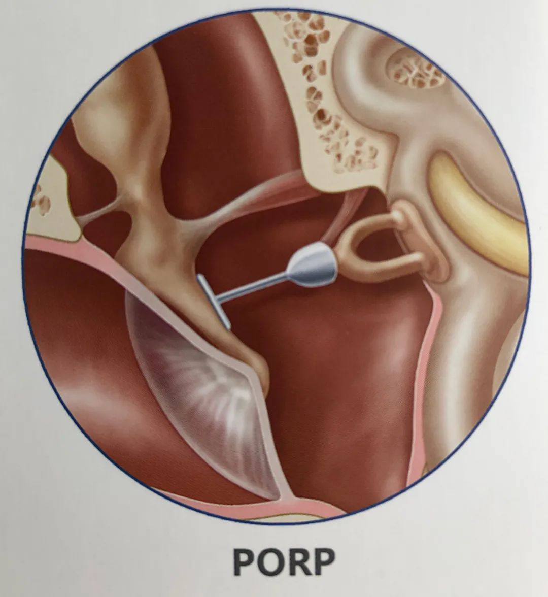 州一医院成功开展首例听力重建术