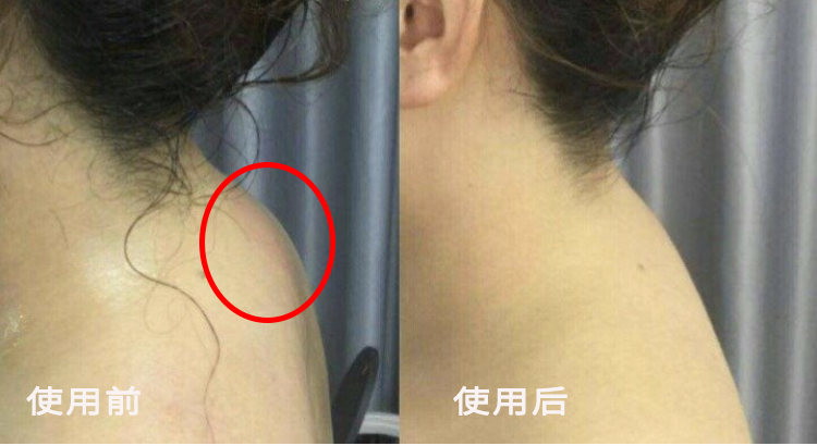 脖子僵硬咔嚓响后面看还虎背熊腰原来是它在作怪