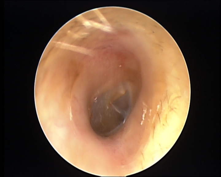 小伙享受了次掏耳朵服务,可怕一幕出现:耳朵里布满密密麻麻的