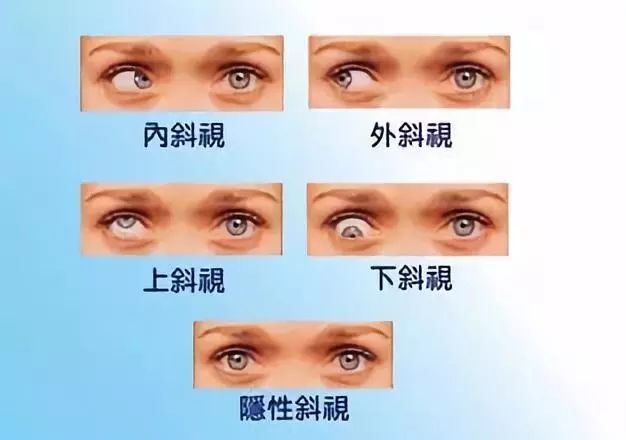 普瑞眼科专家:孩子斜视治疗要趁早!