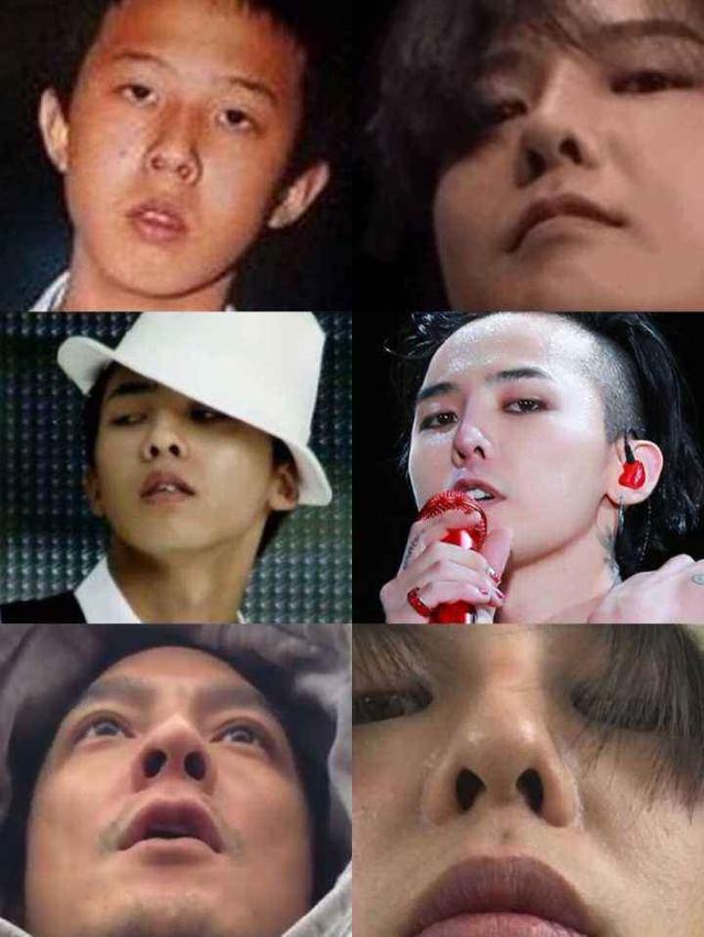 退伍之后整容了权志龙的鼻子怪怪的可能还要恢复恢复