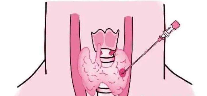 6姐弟3人同患一种癌家人长这种喉结要当心特别是女性