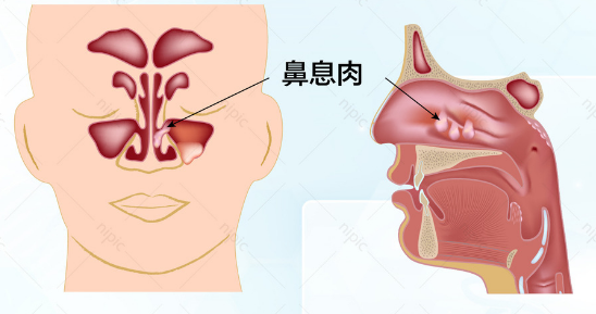 鼻息肉的危害居然这么大